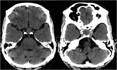 Sellar hemangiopericytoma masquerading as pituitary adenoma: an overlooked intriguing case study unveiling a rare surgical conundrum